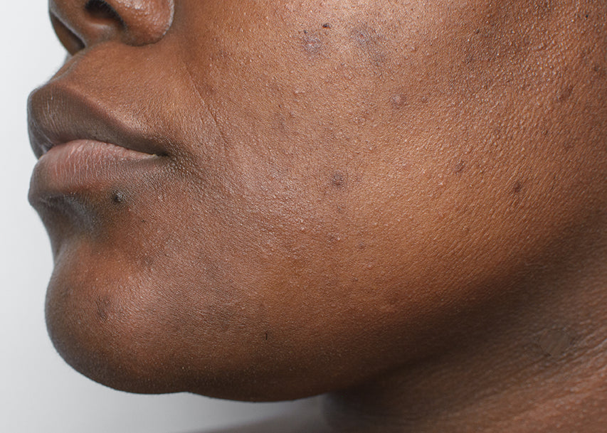 Hyperpigmentation Sign Hyperpigmentation