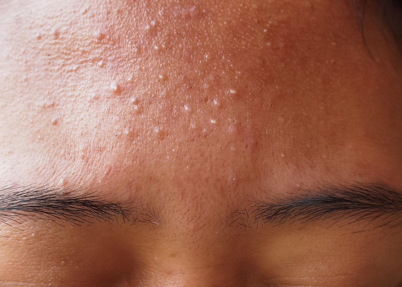 How to Solve Skin Texture Troubles